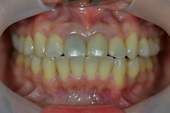 Trước phẫu thuật 1