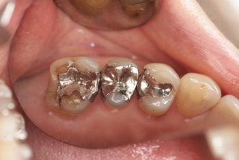 Trước phẫu thuật 2 ngày