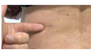 Chỉ với vết mổ 8mm, bệnh nhân có thể phẫu thuật và về trong ngày.