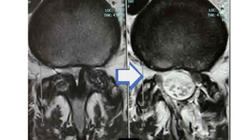 MRI水平断像　圧迫されていた神経根（L5）を含めた硬膜嚢全体が除圧されています