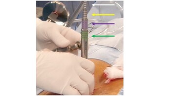 Sử dụng lần lượt 4 ống nong (dilator) để mở rộng đường đi từ da đến xương.