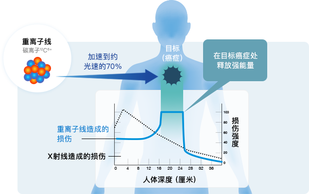 重粒子線治療とは