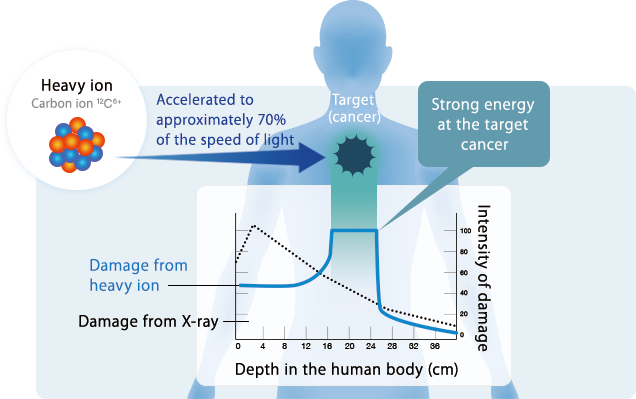 重粒子線治療とは