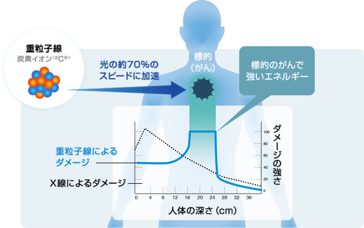 重粒子線治療とは