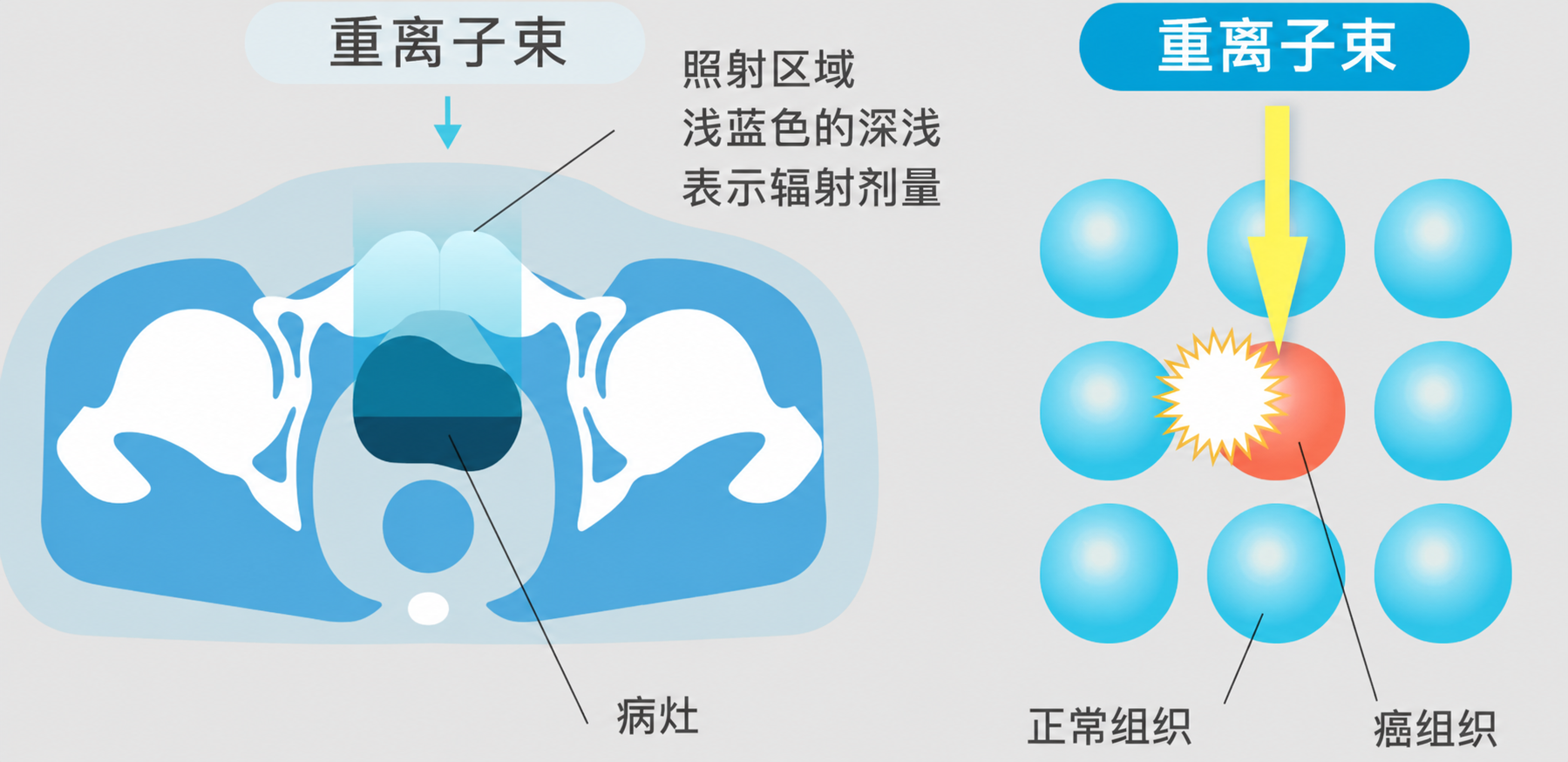 重粒子治疗形象图1