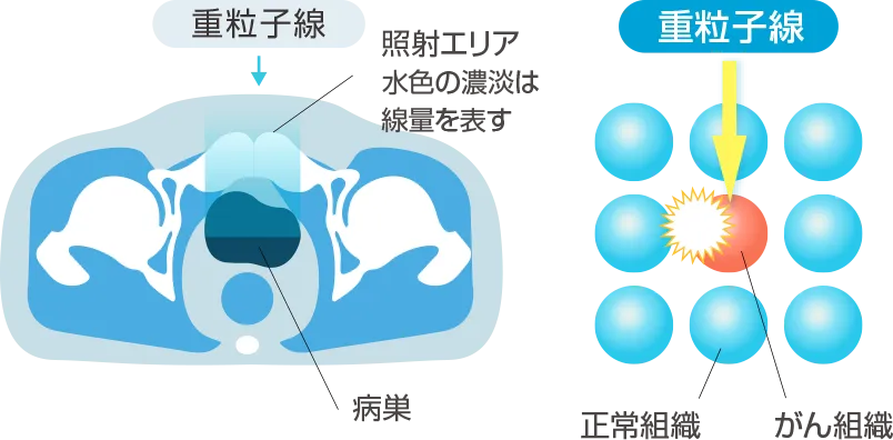 Heavy Ion Therapy Image 1