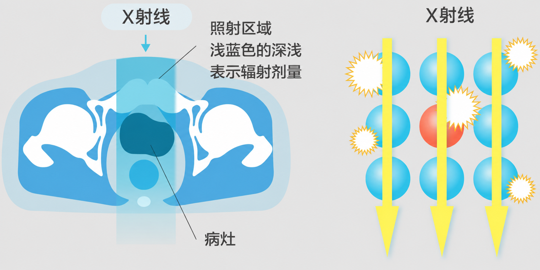 重粒子治疗形象图2